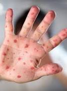 Health Ministry: Over 600 people fall ill with measles in Ukraine over past week