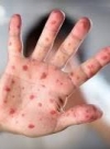 Health Ministry: Over 600 people fall ill with measles in Ukraine over past week